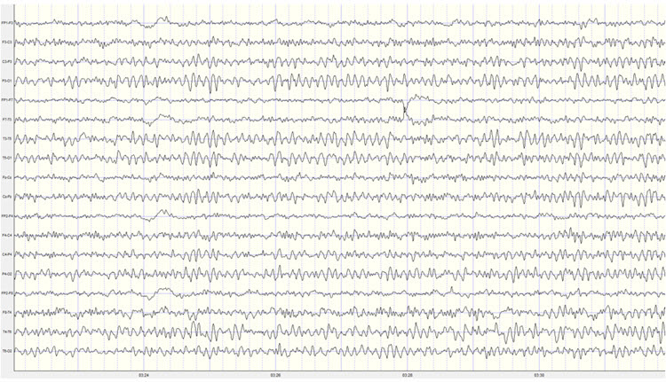 Second recording eyes-closed EEG showing lower amplitude than first recording